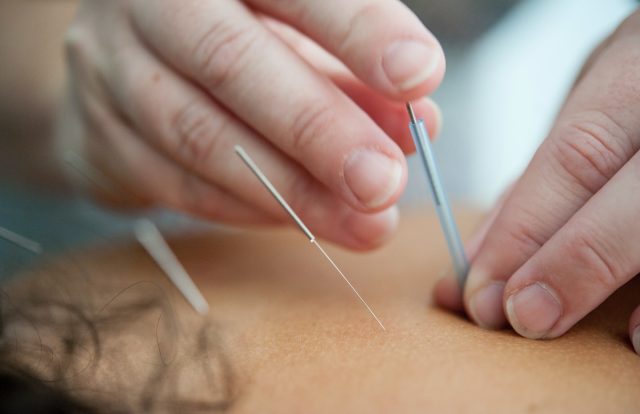 person holding silver and white pen :What is Acupuncture?